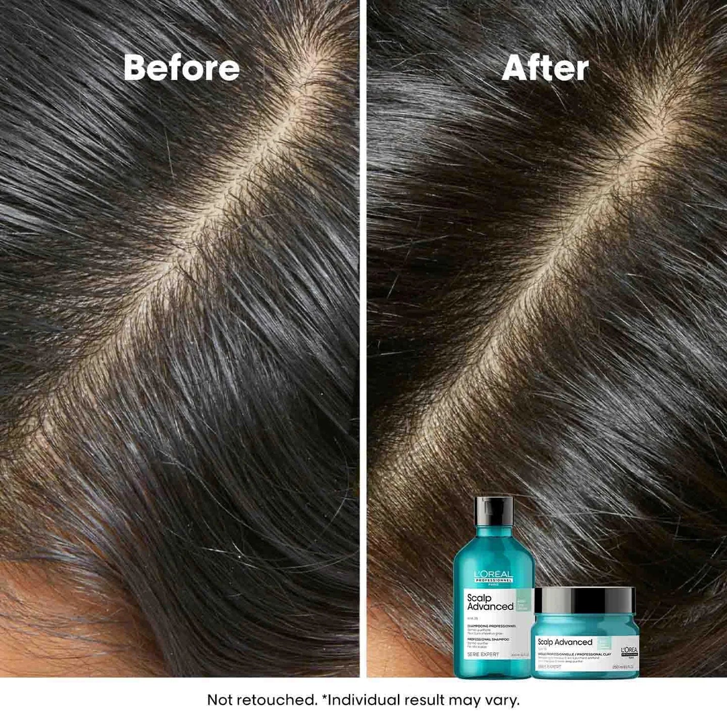 L’Oréal Professionnel Scalp Advanced Anti-Oiliness Shampoo for Oily Scalp, Less scalp sebum, 3% AHA (300ml) Click Beauty